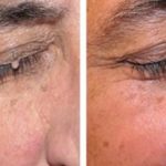 indepartare papiloame acasa